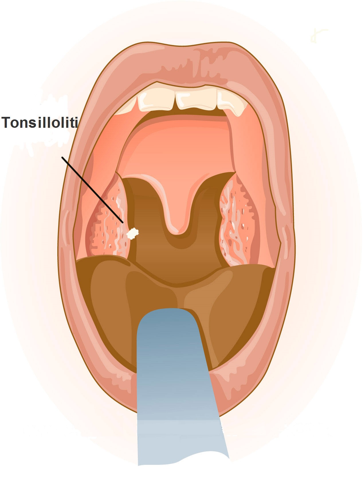 come curare i tonsilloliti